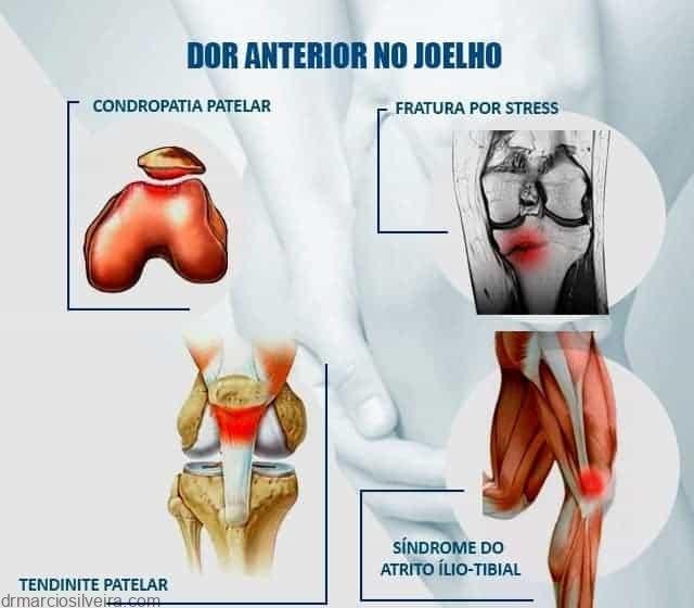 Dor Anterior No Joelho O Que é E Como Tratar Dr Márcio Silveira Ortopedista Especialista Em 1780